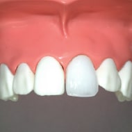 歯科で行う本当のホワイトニング